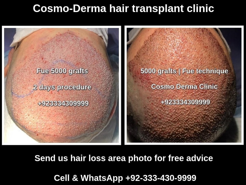 5000 grafts fue hair transplant Lahore Pakistan
