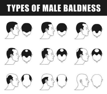Baldness stages