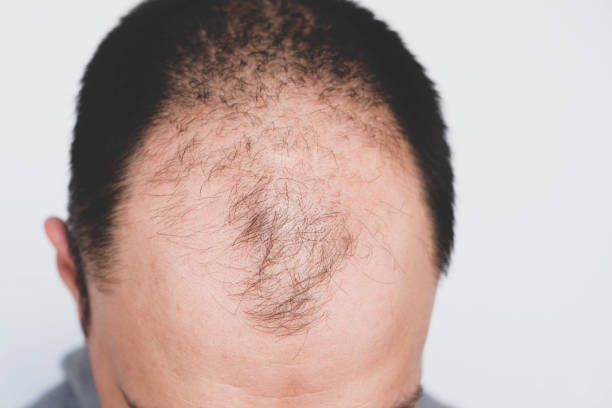 Frontal baldness