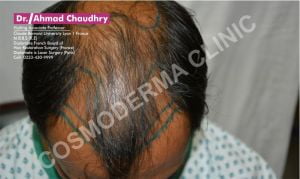 Fue hair transplant technique in Pakistan