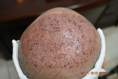 Hair transplant crown