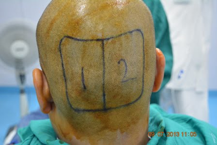 Donor site for hair transplant procedure