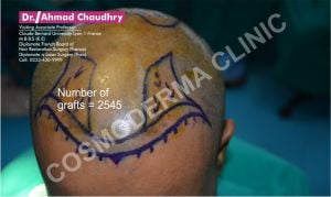 Sugical marking hair restoration Pakistan