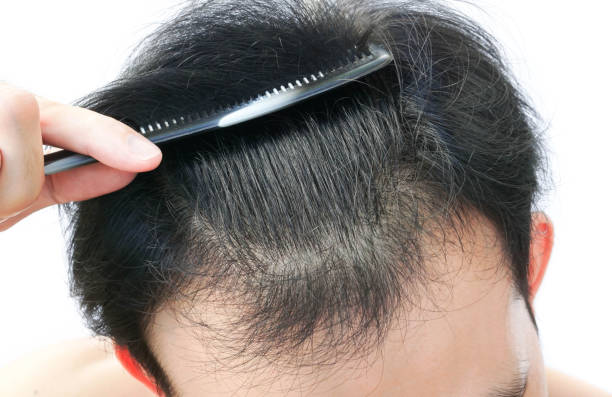 Fue hair transplant results Netherlands