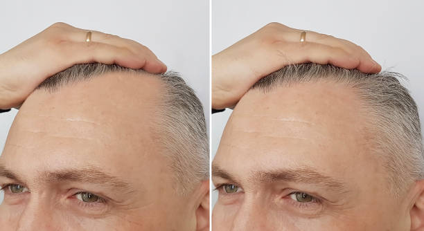 Hair transplant Holland Netherlands