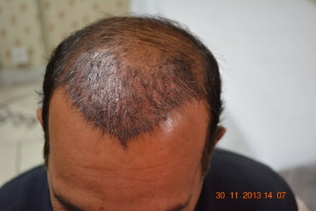 Hair transplant Dublin Ireland cost