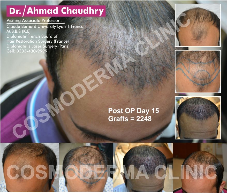 Hair transplant in Alkhobar Saudi Arabia