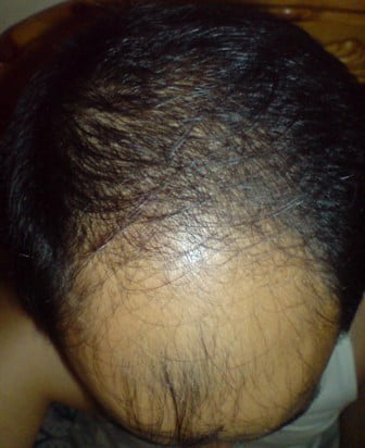 Hair transplant in Yemen