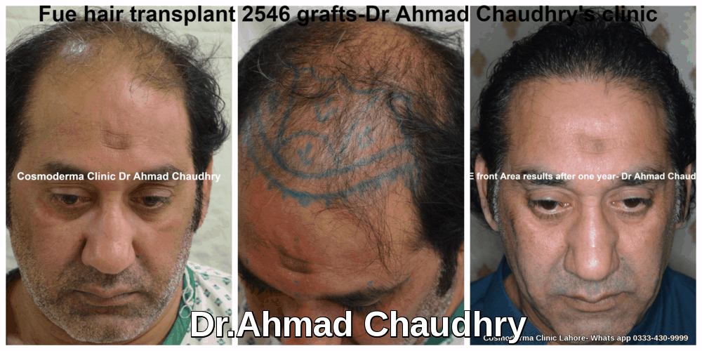 Best hair transplant clinic Lahore