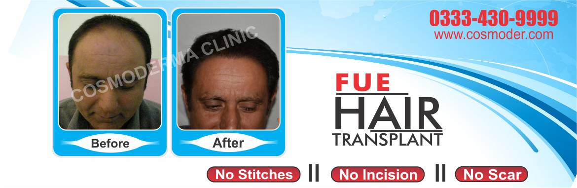 Best hair transplant Pakistan | Free checkup and evaluation call us