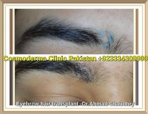 Eyebrow hair transplant clinic results Lahore