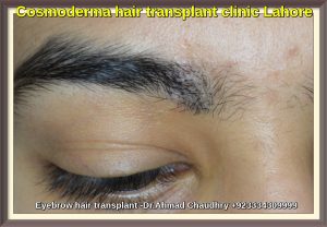 Eyebrow hair transplant in Lahore