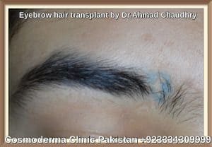 Eyebrow hair transplant in Pakistan