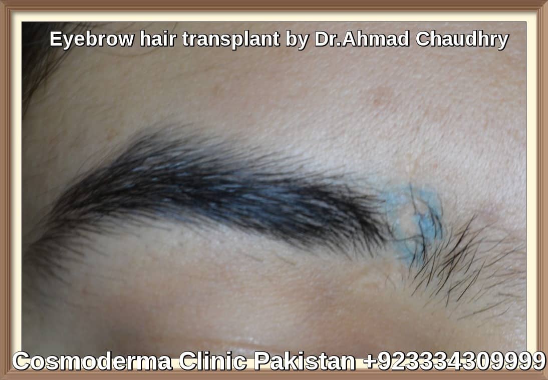 Eyebrow hair transplant Lahore Pakistan Free checkup call us