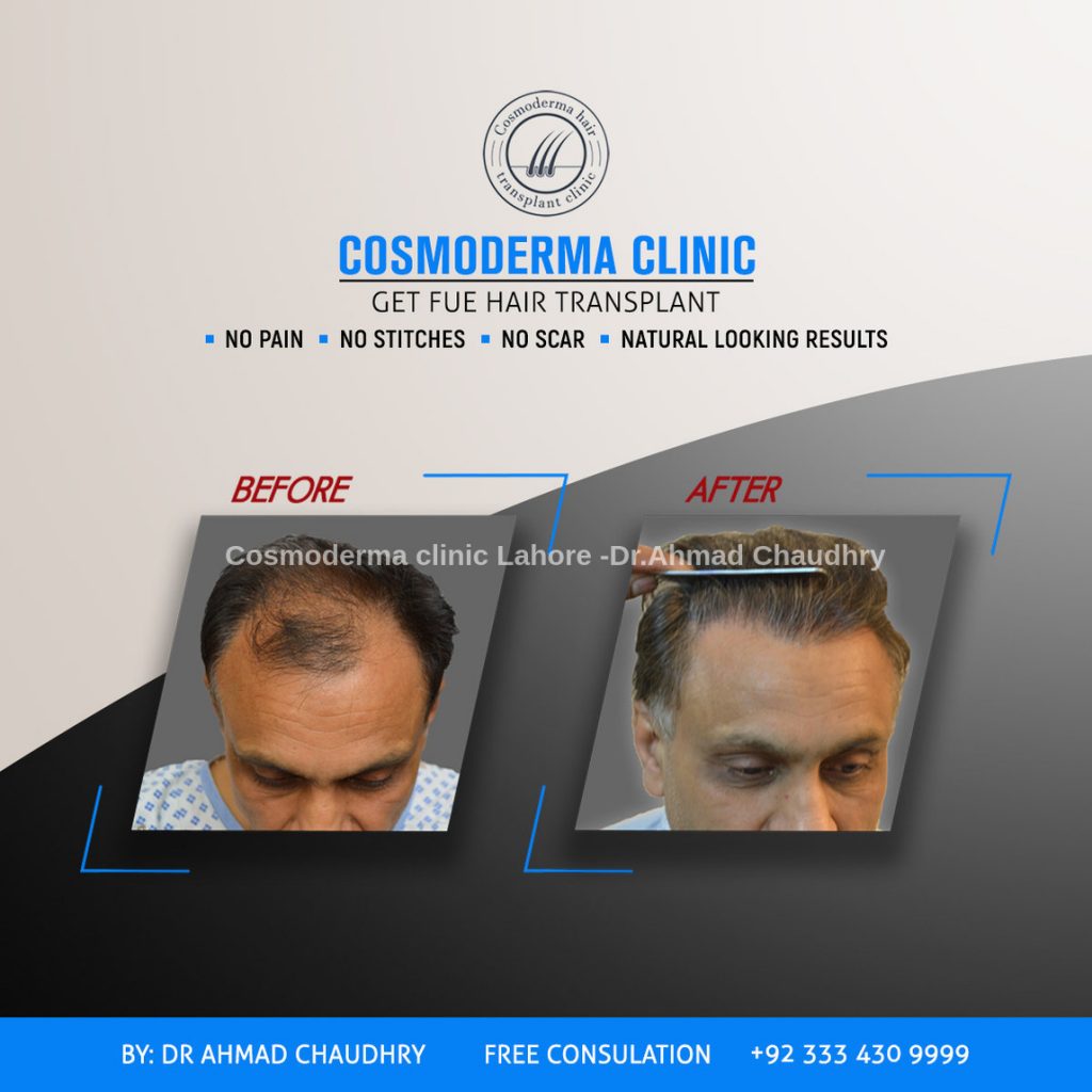 Cosmoderma-hair-transplant-clinic-results-Lahore