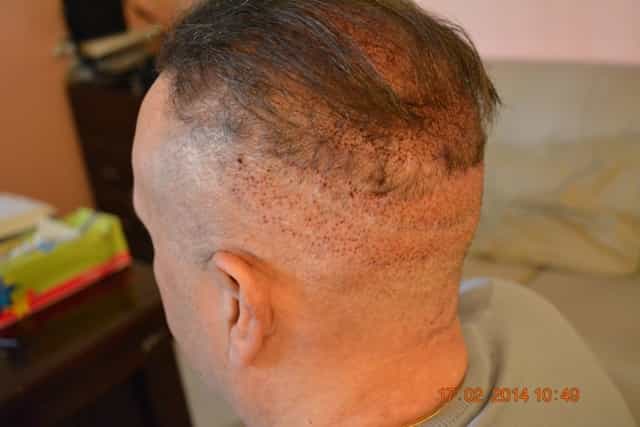 Fue-hair-transplant-Lahore-min