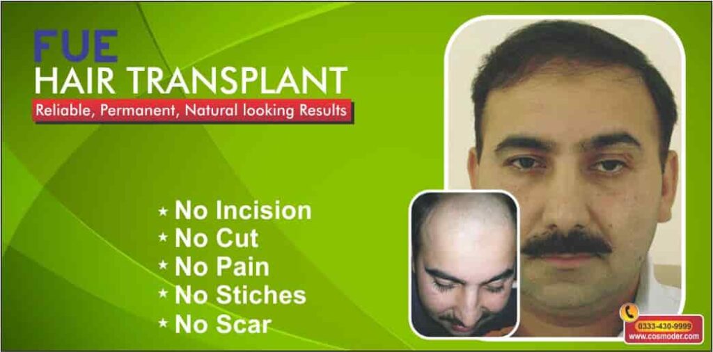 Male-hair-loss-Lahore-min