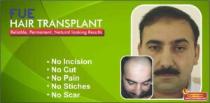 Male-hair-loss-Lahore-min