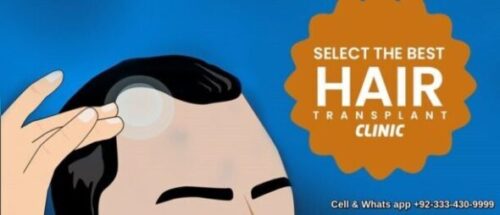 You are currently viewing Hair transplant Lebanon cost