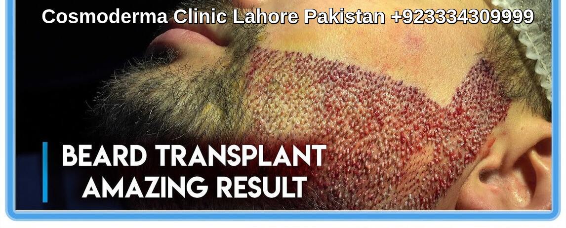 Beard hair transplant Lahore Pakistan