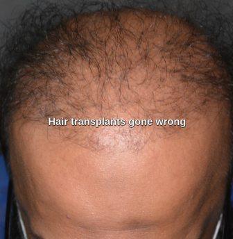 Hair transplant in Mardan