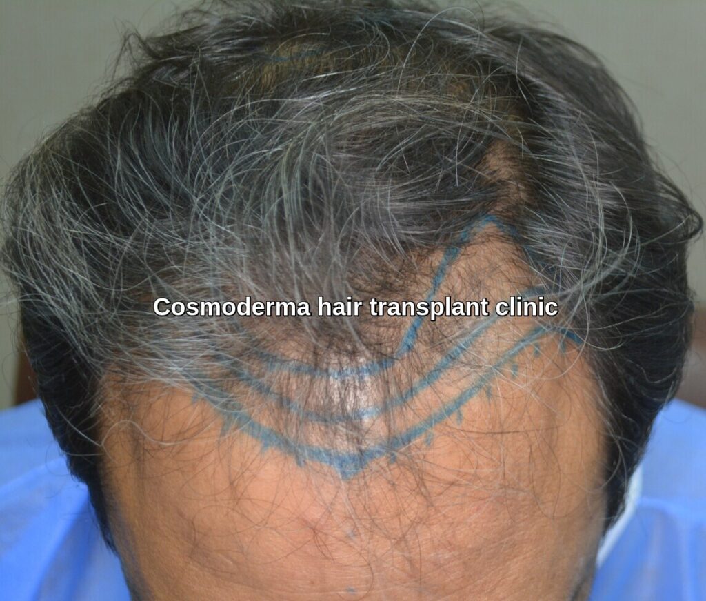 Hair loss treatment Jaranwala