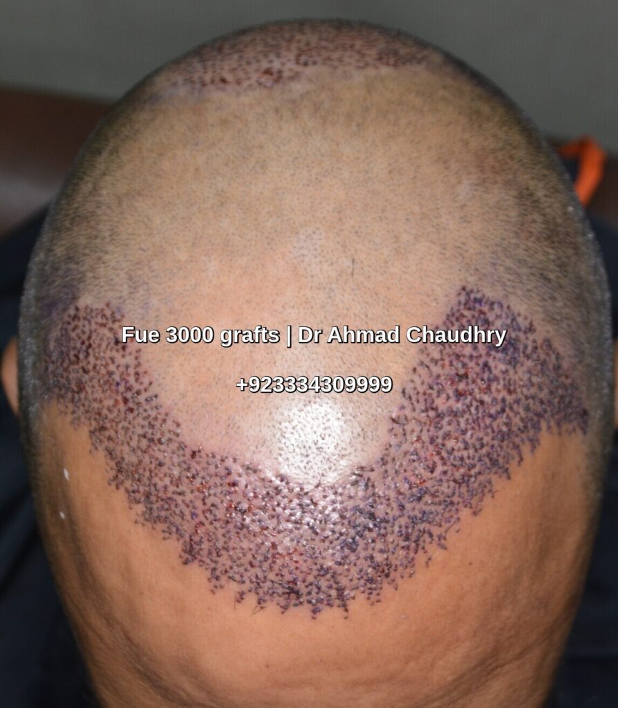 Hair restoration Jarawala Faisalabad