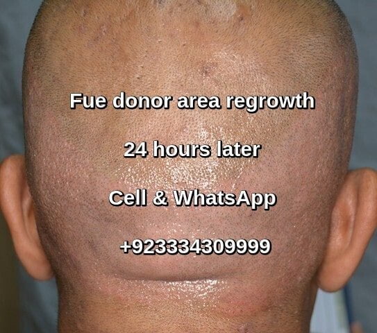 Hair transplant donor area regrowth