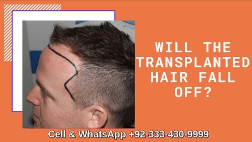 Hair transplant hair life Lahore