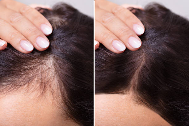 Receding hairline treatment