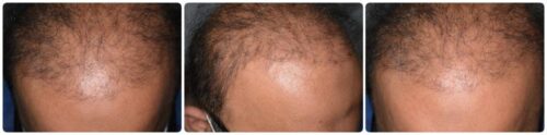 Correct bad hair transplant Lahore Pakistan