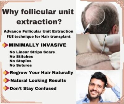 Fue hair transplant Lahore