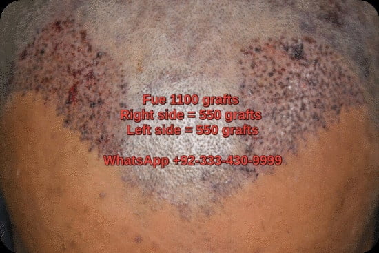 Fue 2202 grafts transplant