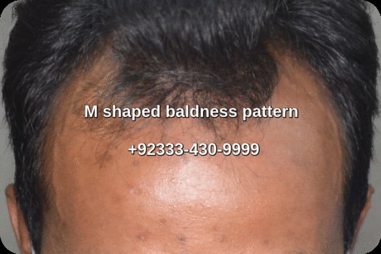 Front corners male pattern baldness