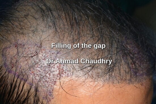 Fue hair transplant Faisalabad patient filling