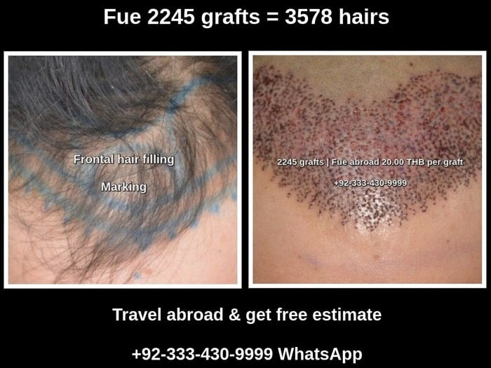 Fue hair transplant Thailand