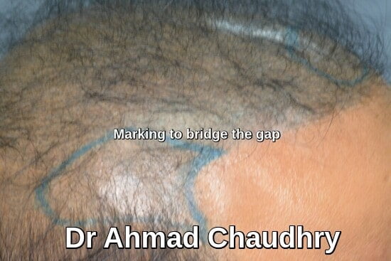 Gap marking for filling hair