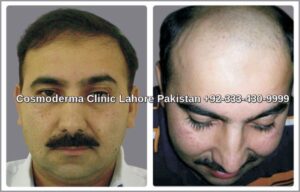 Hair transplant Gujranwala Patient results