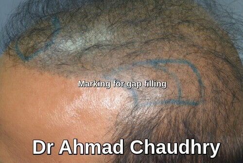 Hair transplant clinic Faisalabad patient gap filling