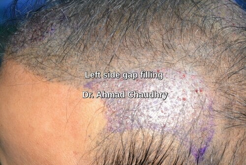 Left side hair transplant repair Faisalabad patient