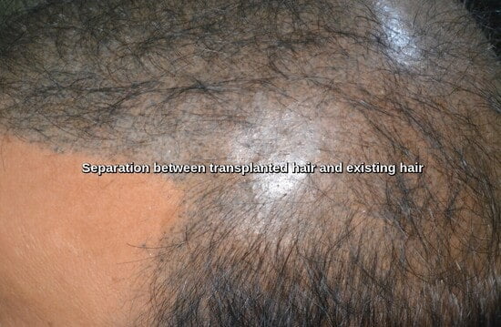 Left side separation between transplanted and existing hair