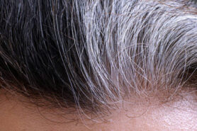 Premature greying of hair