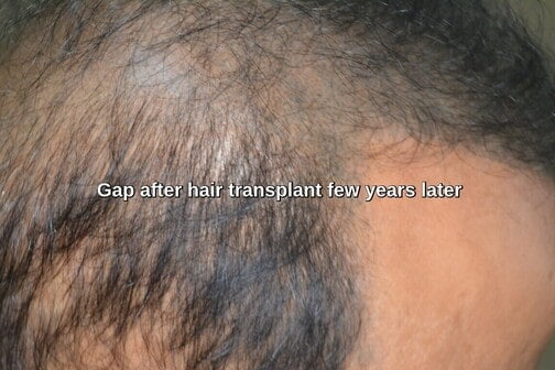 Transplanted hair and existing hair increasing gap