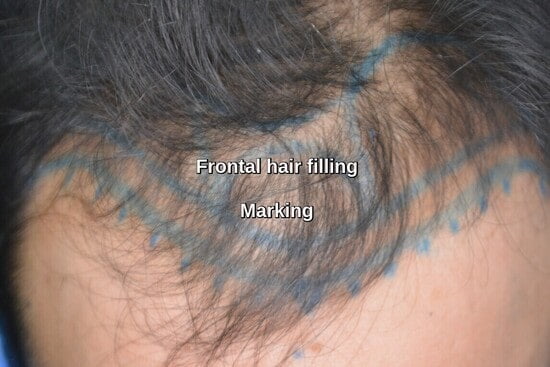 hair loss treatment Thailand