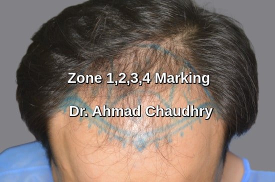 Baldness Sharaqpur patient