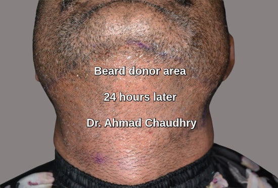 Beard donor area grafts extraction