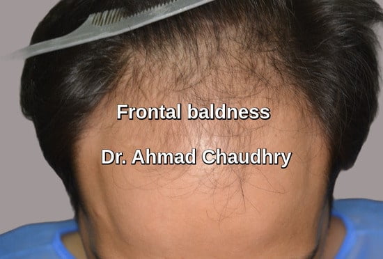 Frontal baldness Sharaqpur Sharif