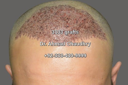 Frontal view 3133 grafts -Fue hair restoration