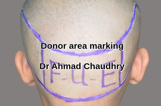 Fue hair transplant donor area Sharaqpur patient