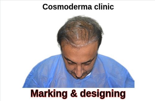 Hair restoration repair planning